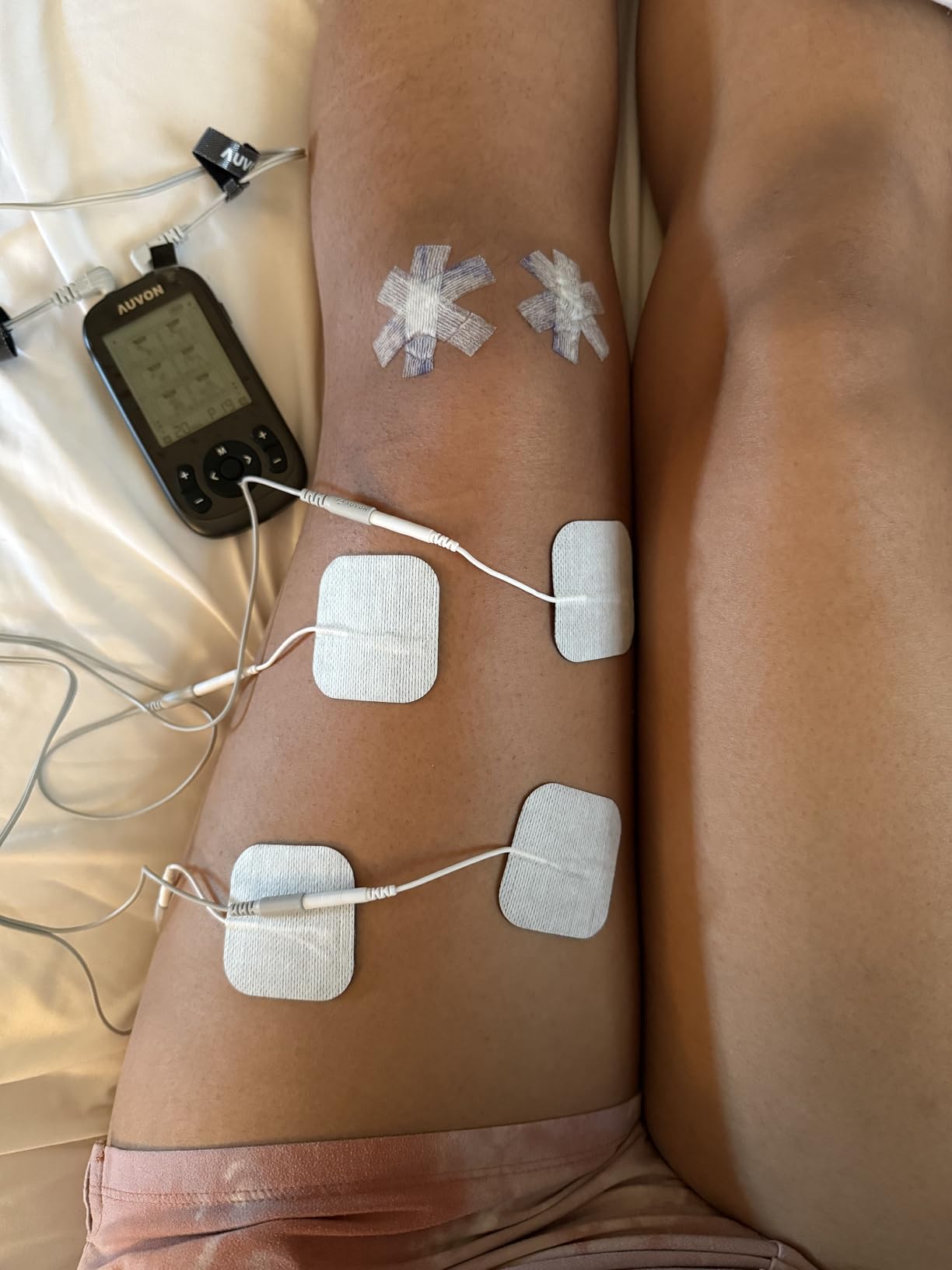AUVON 3-in-1 TENS Unit Muscle Stimulator, 40 Levels for Gradual Pain Relief | EMS Massage Machine, Drug-Free for Shoulder, Sciatica, Back Pain Relief, 24 Modes Electronic Pulse Massager, 12 TENS Pads customer photo 1